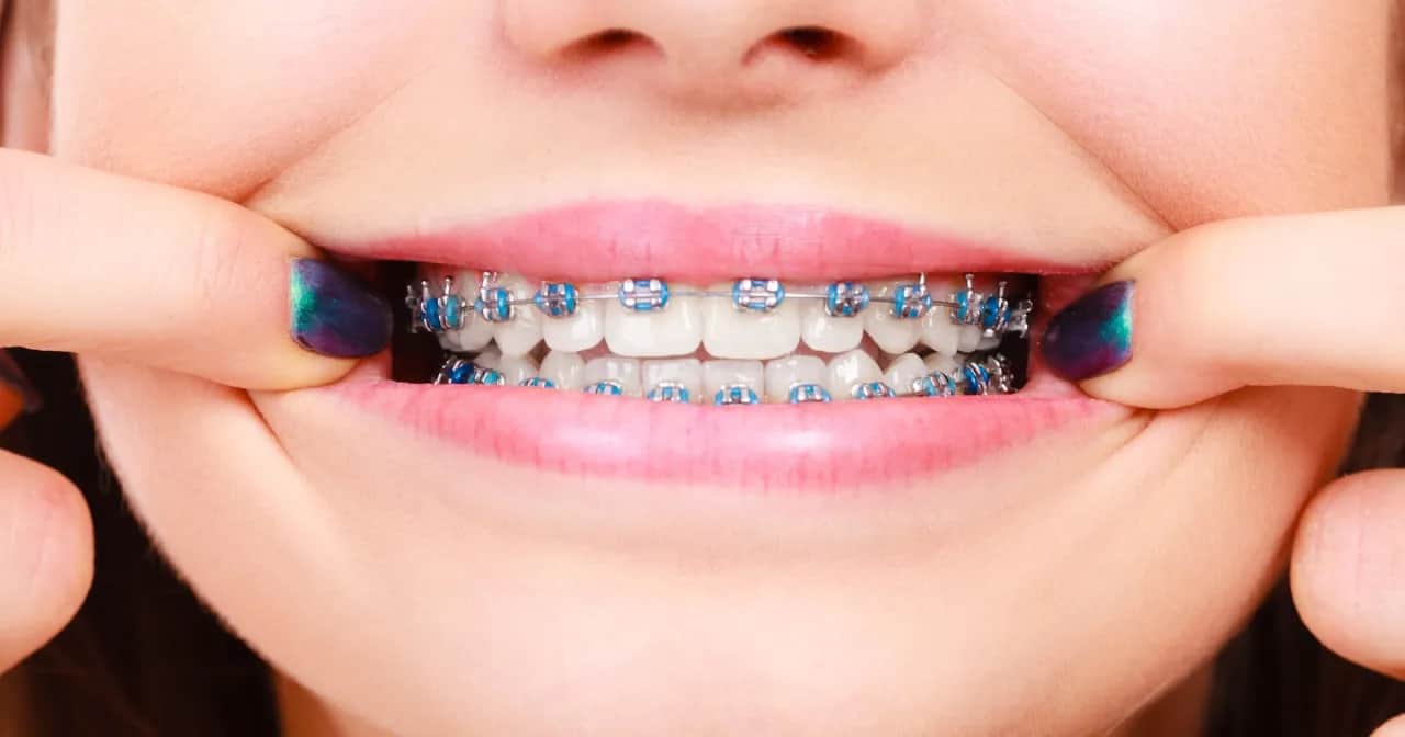 Aparat ortodontyczny: Całkowity koszt leczenia od A do Z w Polsce