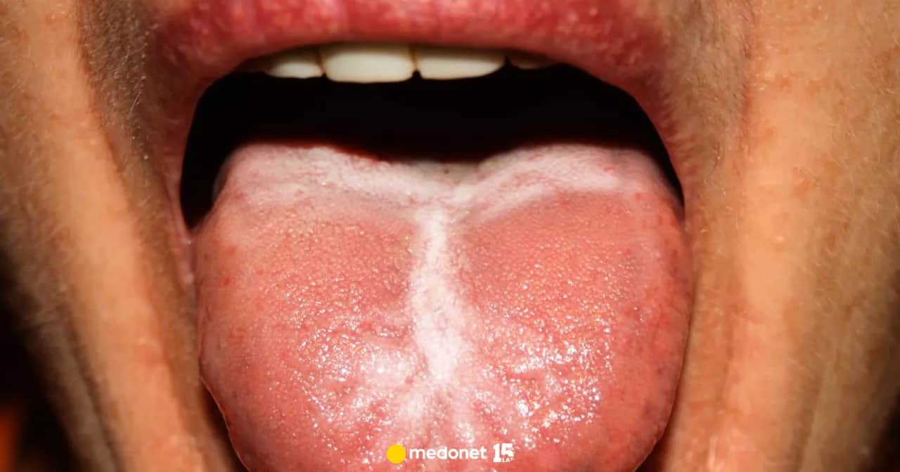 Alergia jamy ustnej: swędzenie po jedzeniu? Poznaj objawy i leczenie