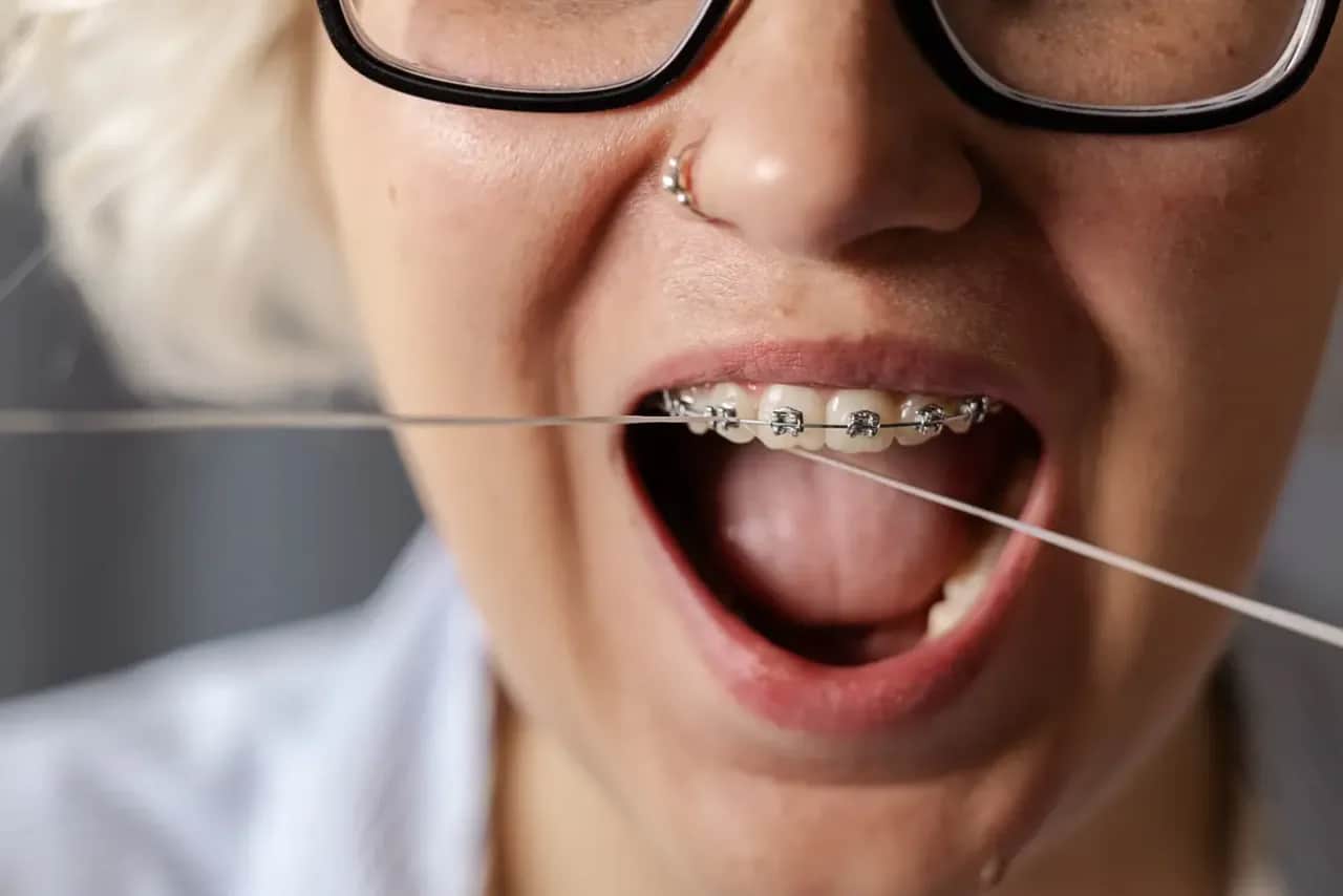 Aparat na zęby (góra+dół): Całkowity koszt i jak go sfinansować?