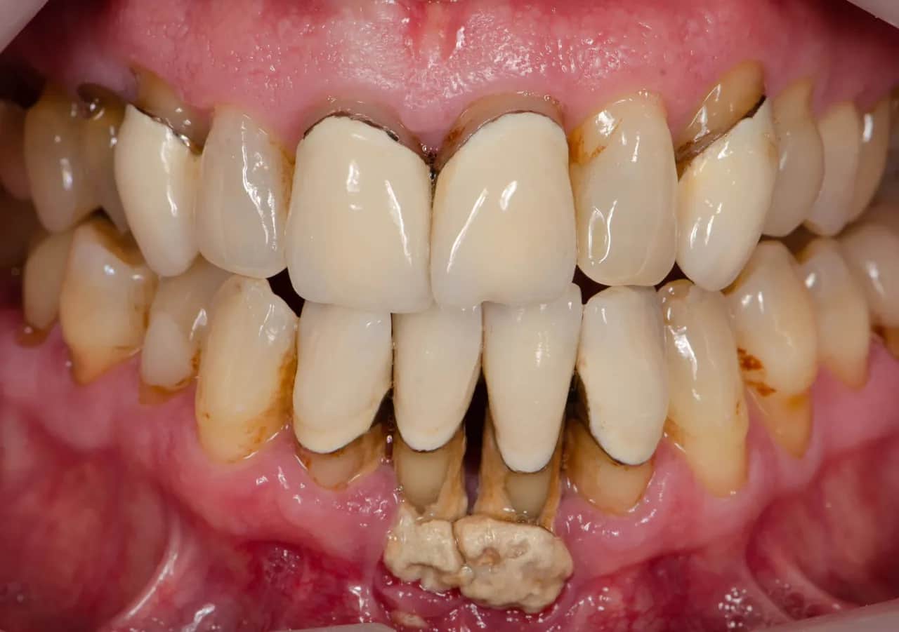 Ile trwa zapalenie dziąseł? Skróć leczenie i uniknij paradontozy!