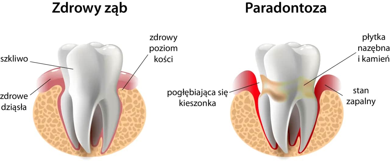 Zdrowe dziąsła: Jak dbać, by uniknąć paradontozy i krwawienia?