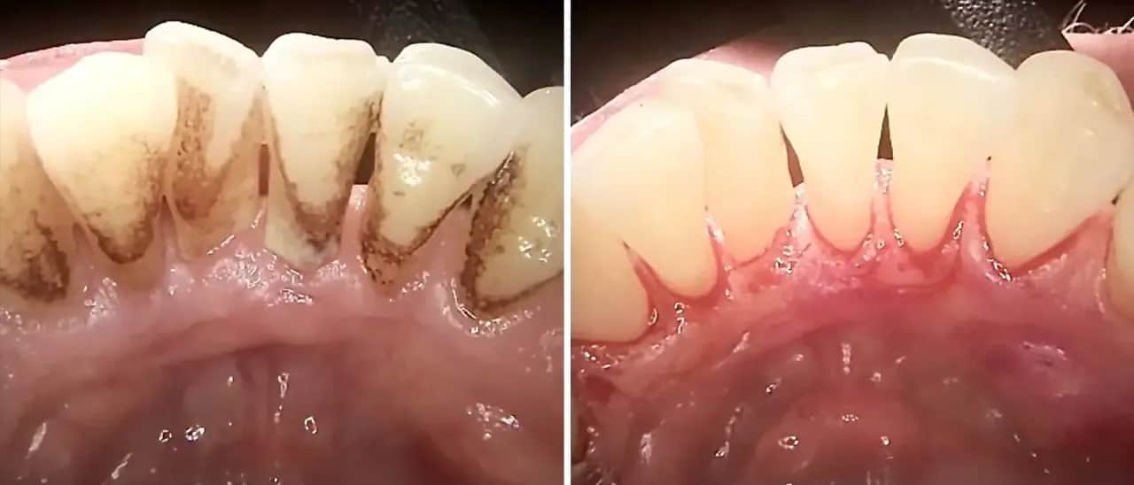 Zapalenie dziąseł: czy rozpoznasz objawy? Szybka pomoc!