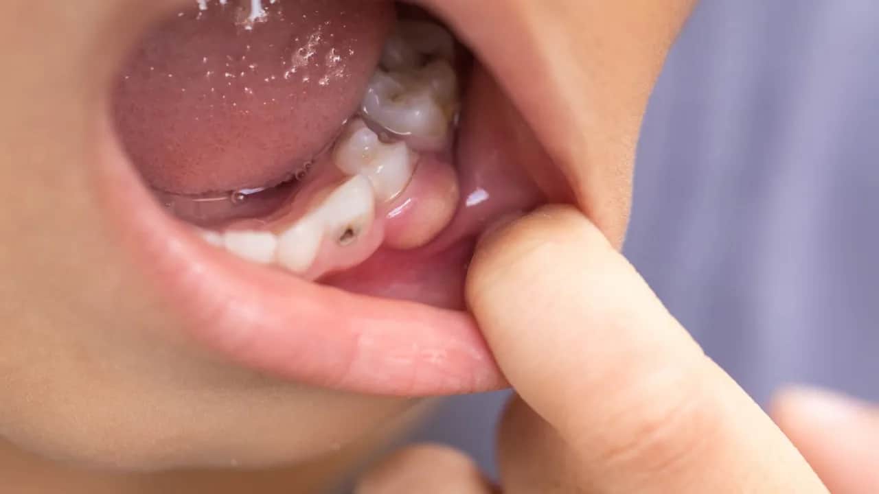 Ropa w dziąśle: Jak szybko złagodzić ból i co dalej?